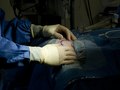 Brain Surgery