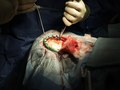 Brain Surgery
