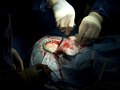 Brain Surgery