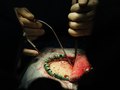 Brain Surgery