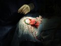 Brain Surgery