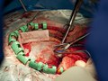 Brain Surgery