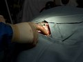 Brain Surgery