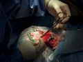 Brain Surgery