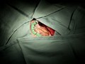 Brain Surgery