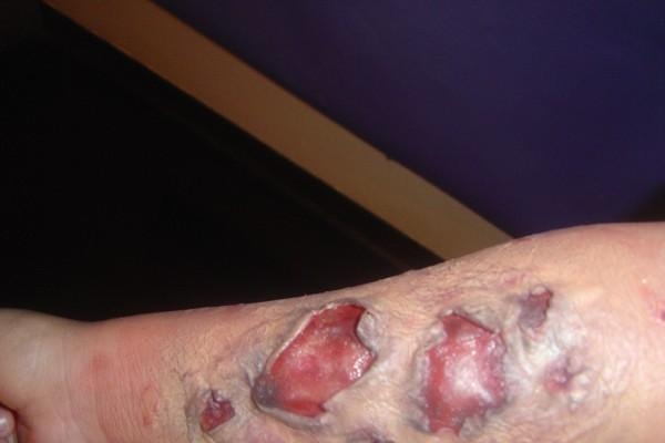 3rd Degree burn & Blisters