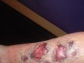 3rd Degree burn & Blisters
