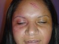 Cat Scratches, Fresh Brusing, Cut's,